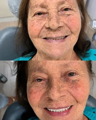 Antes e depois de reabilitação oral com prótese em paciente idosa